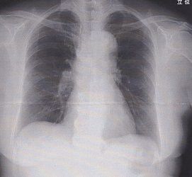 肺がん2