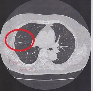 肺がん改善4