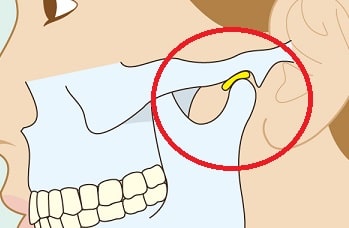 寿楽鍼灸整骨院　顎関節症9
