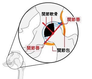 大腿骨頭壊死タイプB