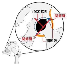 大腿骨頭壊死タイプC1