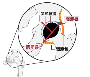 大腿骨頭壊死タイプC2
