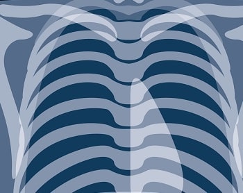 肺小細胞癌とは