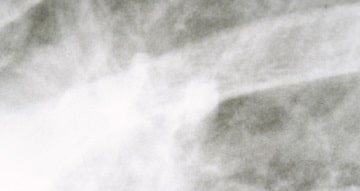 放射線療法の目的