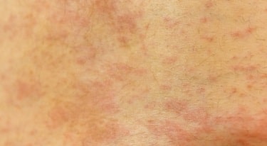 免疫チェックポイント阻害薬