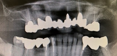 咀嚼筋腱腱膜過形成症　レントゲン