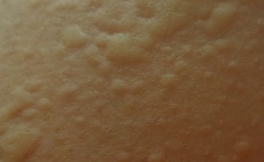 食物アレルギーの成因