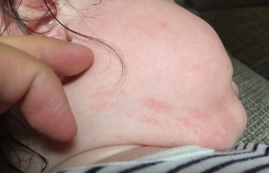 アナフィラキシーショック