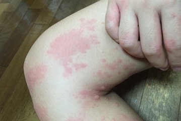 食物アレルギーの疫学