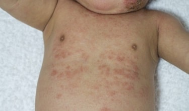 薬物アレルギー2