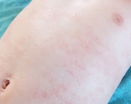 湿疹(しっしん)