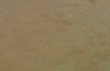 蕁麻疹(じんましん)