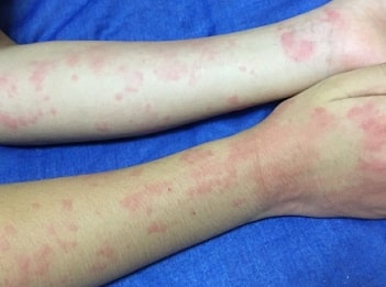 食物アレルギー