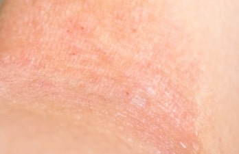 アトピーとアレルギー