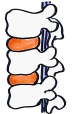 椎脊柱管狭窄する理由