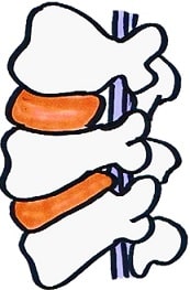 椎脊柱管狭窄症の合併症