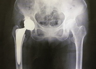 ステロイドが及ぼす影響