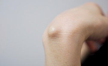 ガングリオンの好発部位