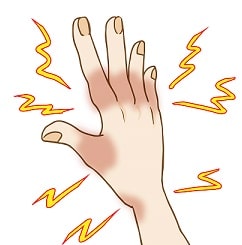 痛風の好発部位