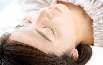 美容鍼とリフトアップ