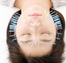 頭部、顔面部、頚部への鍼