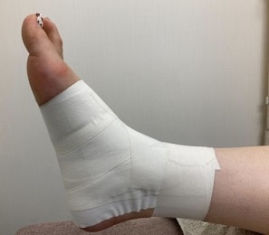 足関節捻挫