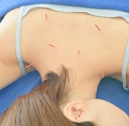 脳梗塞の治療から生まれた緑内障の治療