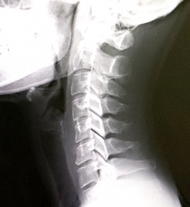 鍼灸院 整骨院 整体 針治療 カイロプラクティック 緑内障4