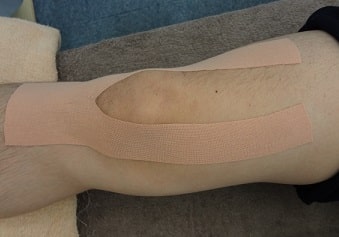 後十字靭帯損傷の治療法