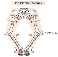 偽性軟骨無形成症