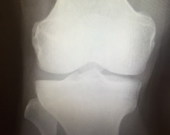 オスグッド・シュラッターとは