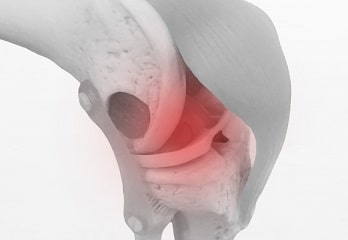 半月板損傷とは