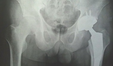 変形性股関節症