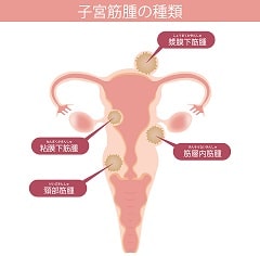 子宮筋腫