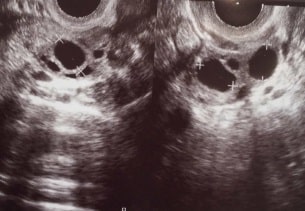 卵巣過剰刺激症候群