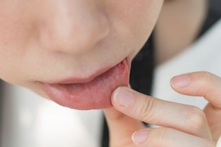 口内炎の東洋医学的考察