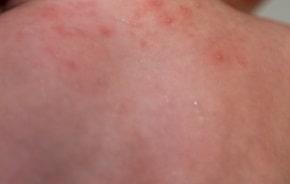 アトピー性皮膚炎患者と癌の関係