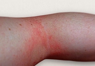 犬との暮らしが子供の食物アレルギーを予防