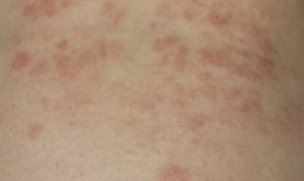 離乳期早期からの加熱卵摂取は卵アレルギーを予防