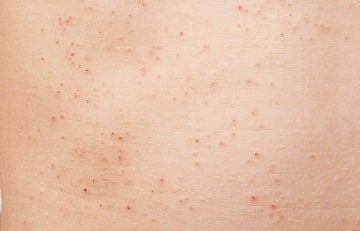 乳幼児のアトピー性皮膚炎を予防するための保湿剤や補完食導入は効果が証明されなかった