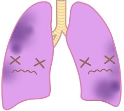 非結核抗酸菌(NTM)の種類