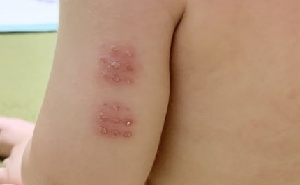 非結核性抗酸菌症は完治するのか?