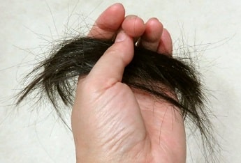 甲状腺機能低下症の肝腎陰虚による脱毛、薄毛、抜け毛の鍼灸