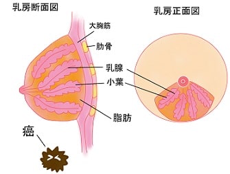 上皮内癌の代表的なもの