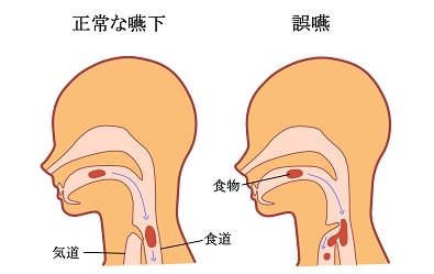 嚥下障害の部位