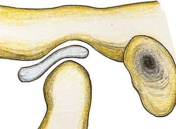 顎関節症を治すのは大変ですか？