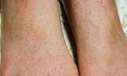 寿楽鍼灸整骨院　紫斑病