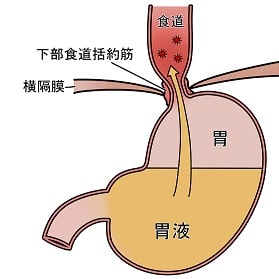 食道裂孔ヘルニアとは