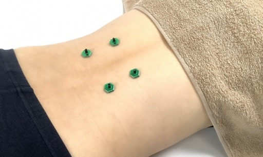 心因性発熱（機能性高体温症）5