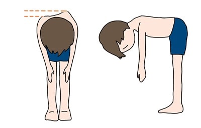 脊柱側弯症（せきちゅうそくわんしょう）5